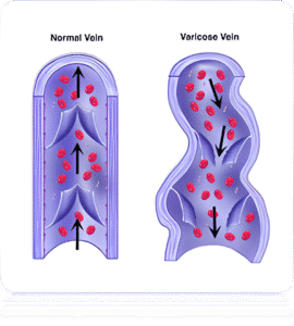 Varicose Veins